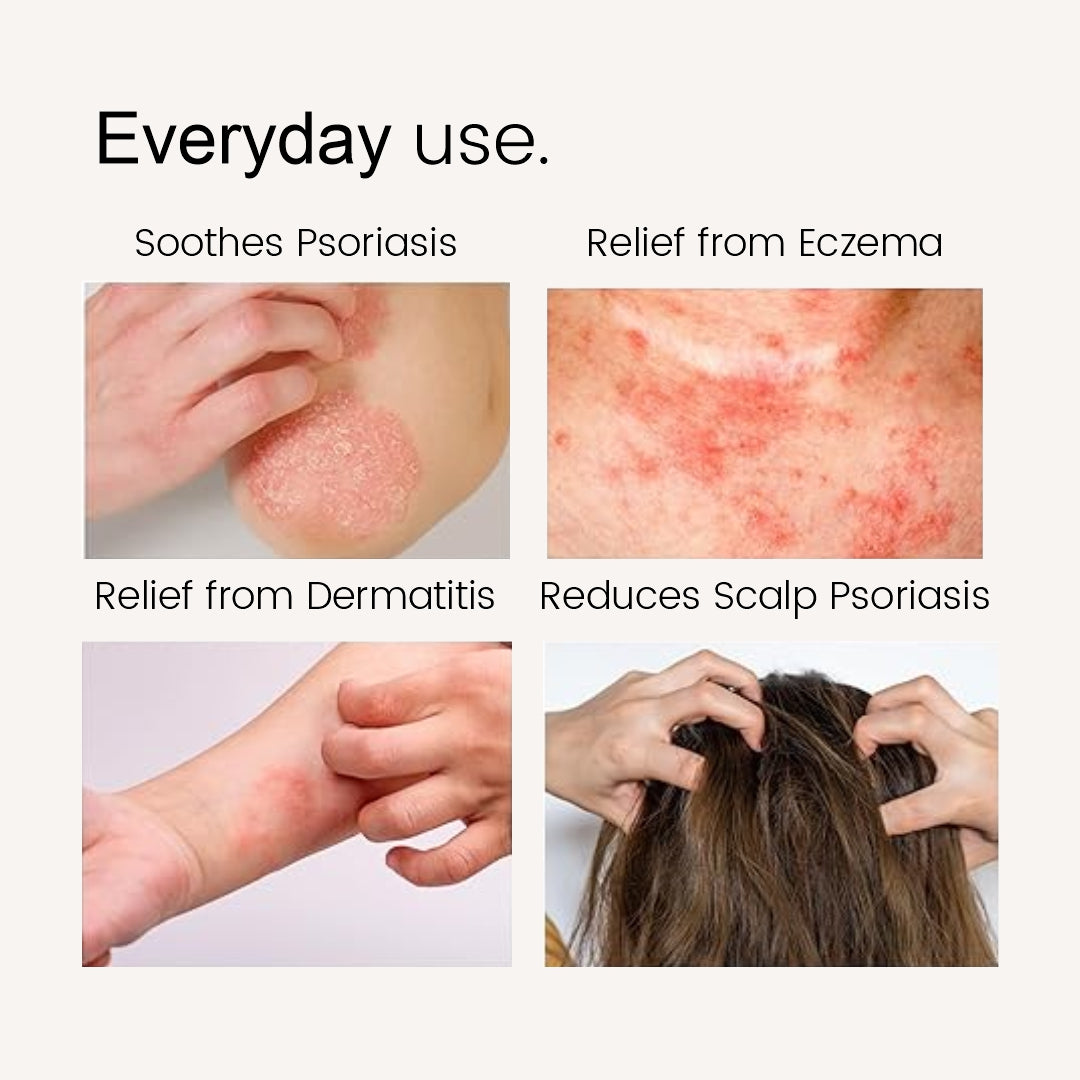Aaro Psoriasis Oil & Tablets